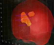 3D Mapping Biopsy